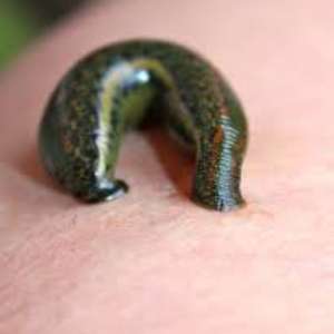 raktamokshana therapy